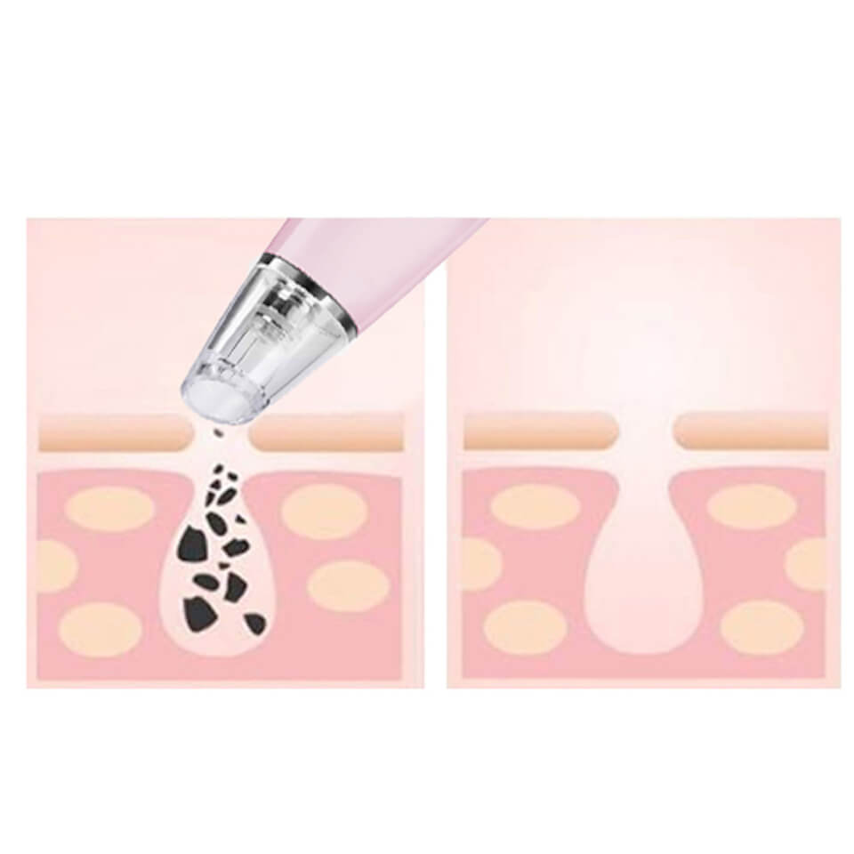 MAGNITONE London PorePatrol Skin Renewing Pore Extraction System - Pink