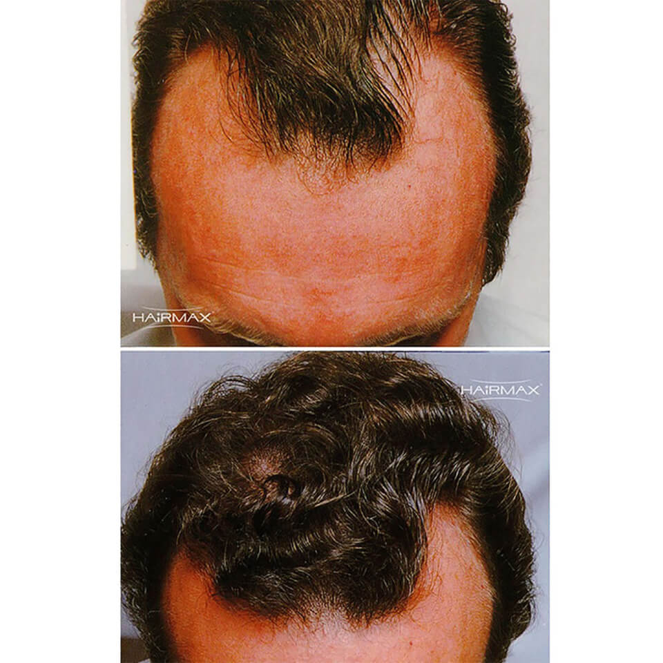 Hairmax Density Activator - Folicle Booster