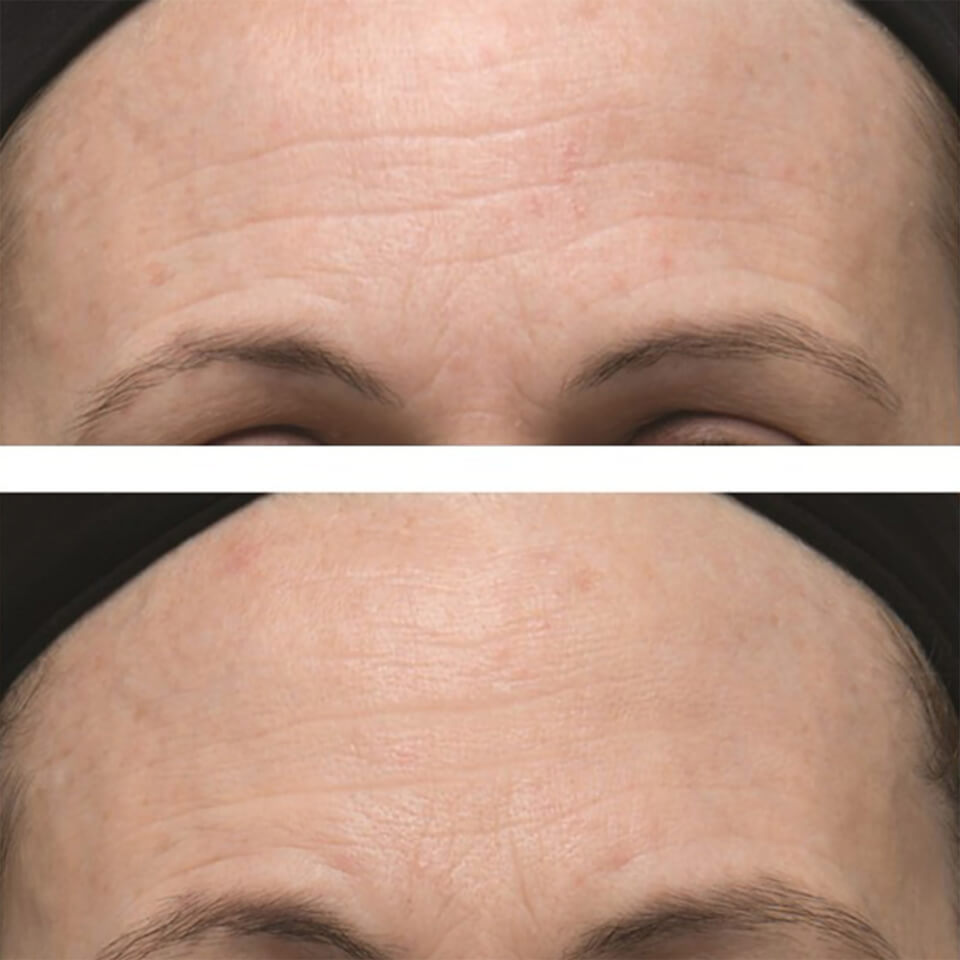 Dr. Dennis Gross Skincare Alpha Beta Ultra Gentle Daily Peel 5 Treatments