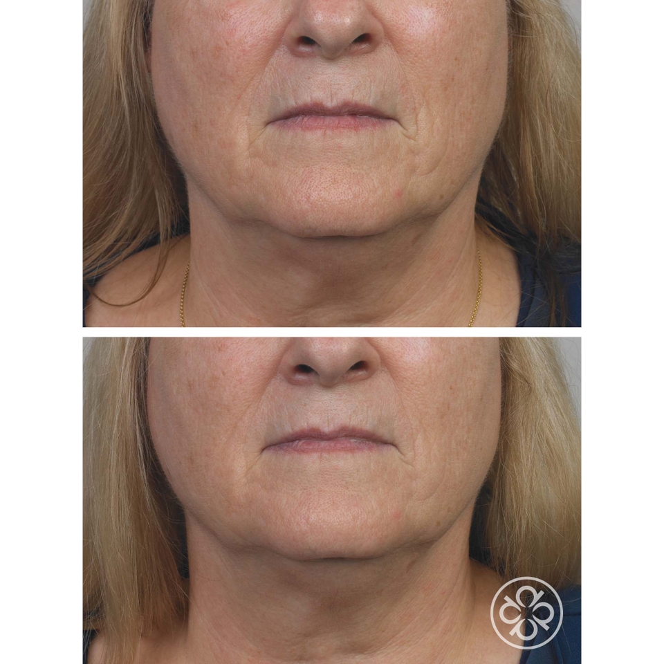 Micro-Retinol Essential Moisturizer