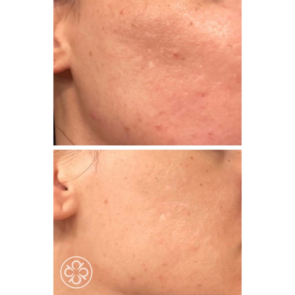 ProCorrective Clear-Control Blemish Treatment