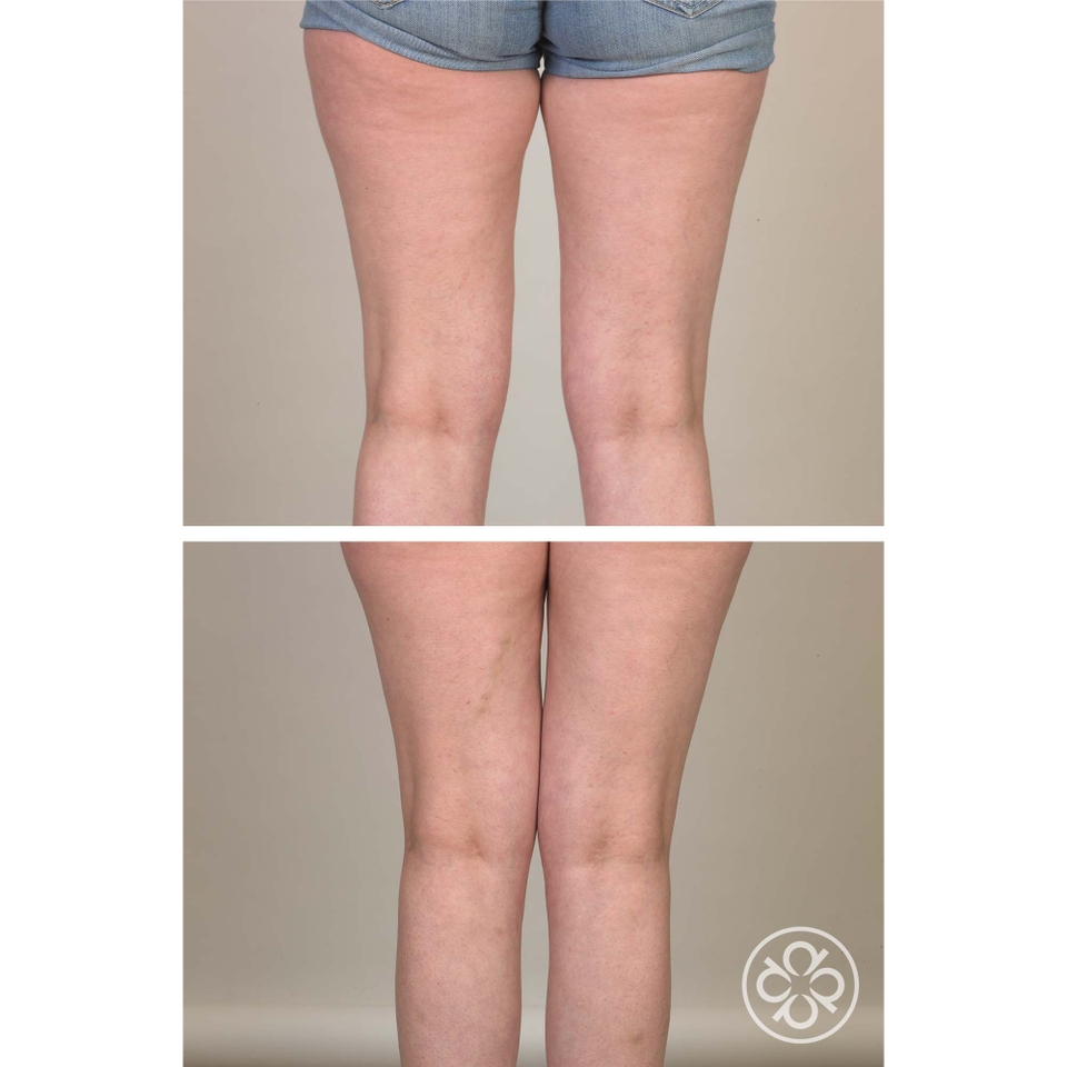 Crepe-No-More Body Cream
