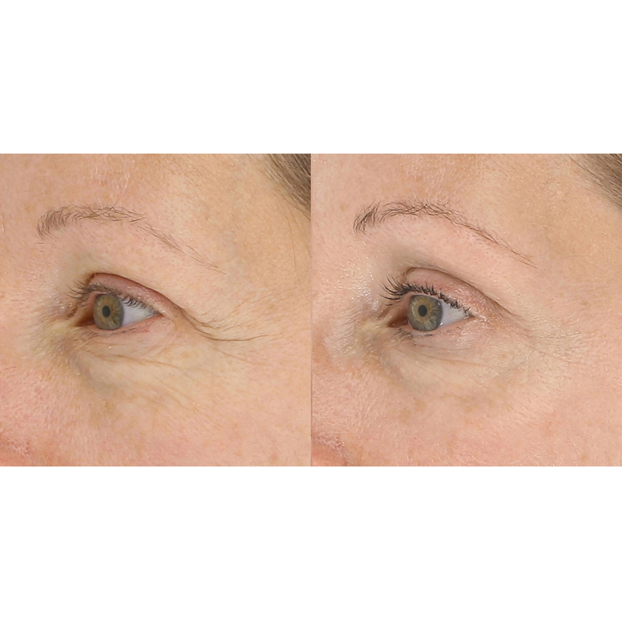 Anti-aging reduce selling wrinkles LIGHTSTIMnLightStim for Wrinkles