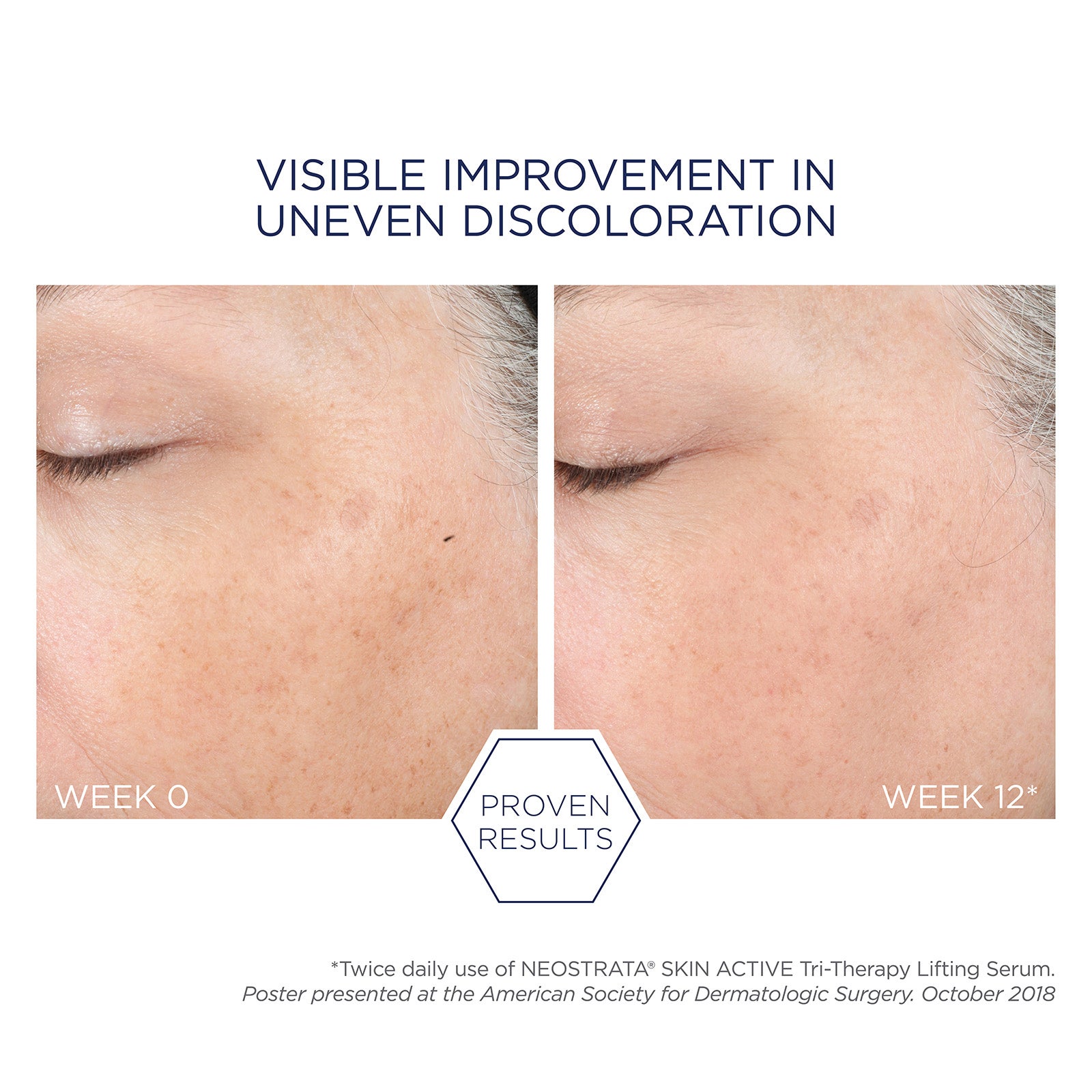 NEOSTRATA Skin Active Tri-Therapy Lifting Serum with Hyaluronic
