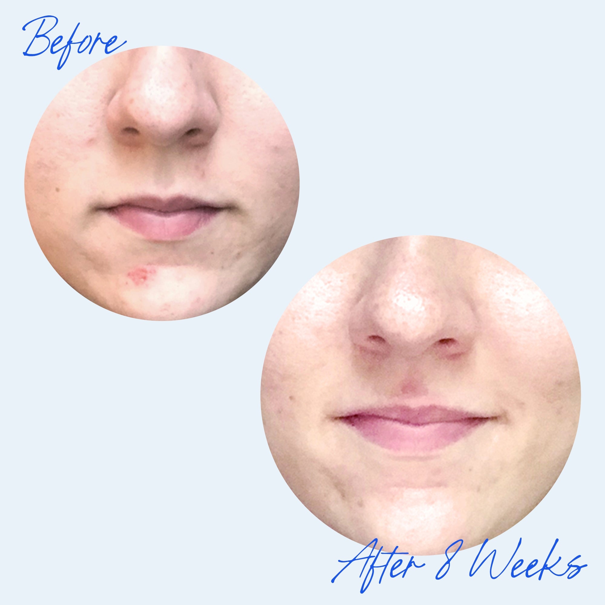 Acne Relief Prebiotic Acne Therapy 30-Day Regimen | Perricone MD