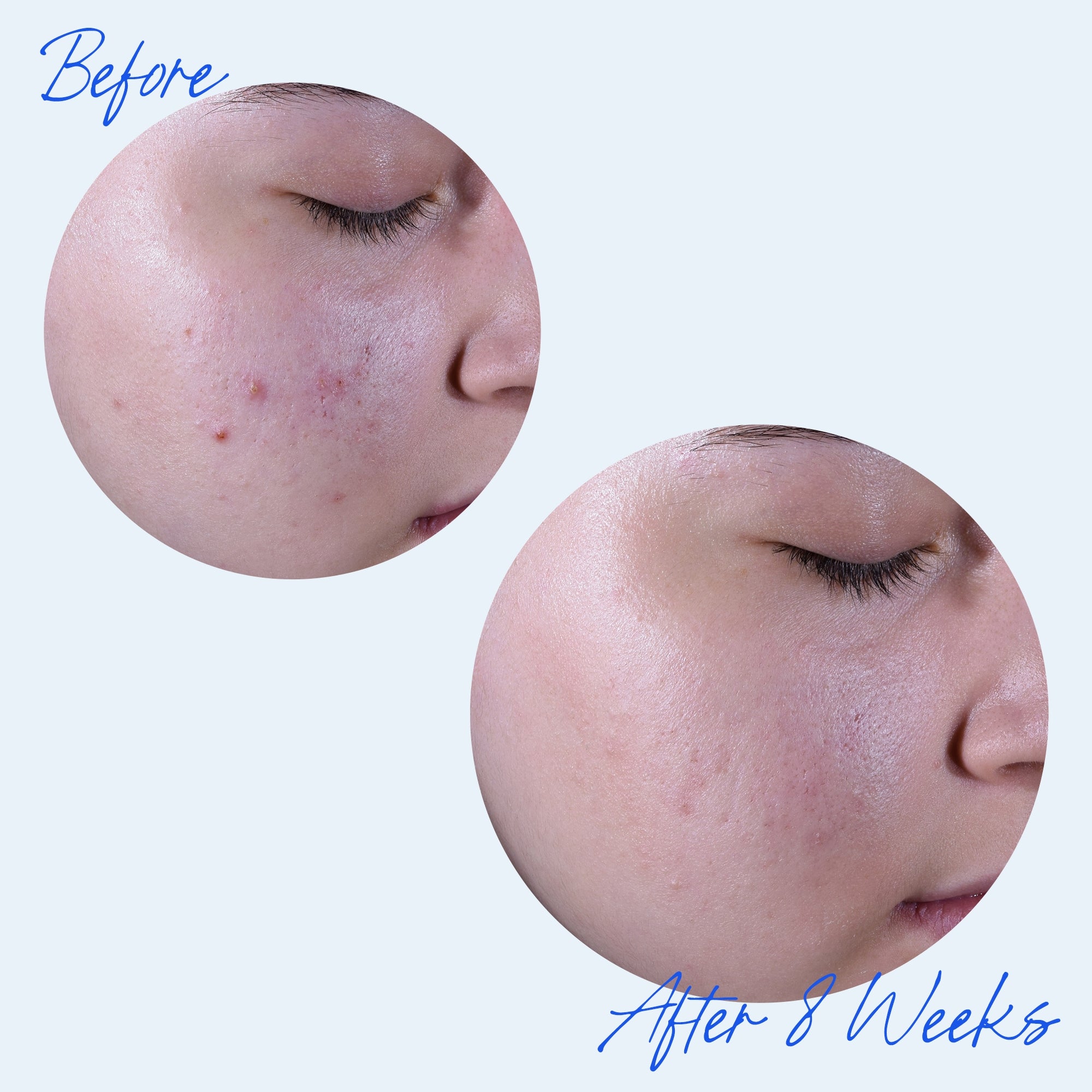 Acne Relief Maximum Strength Clearing Treatment | Perricone MD
