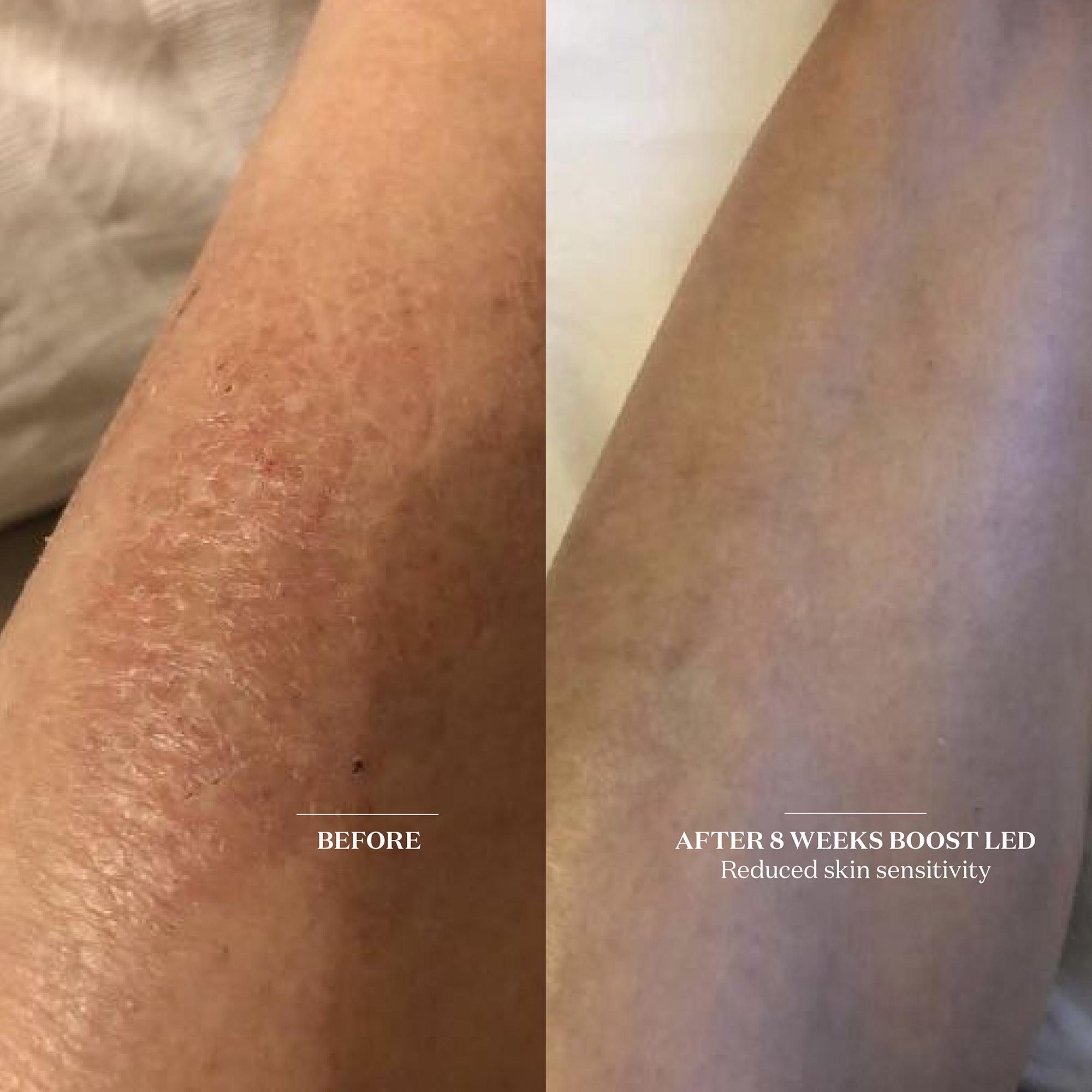 The Light Salon Boost LED Patch | Dermstore