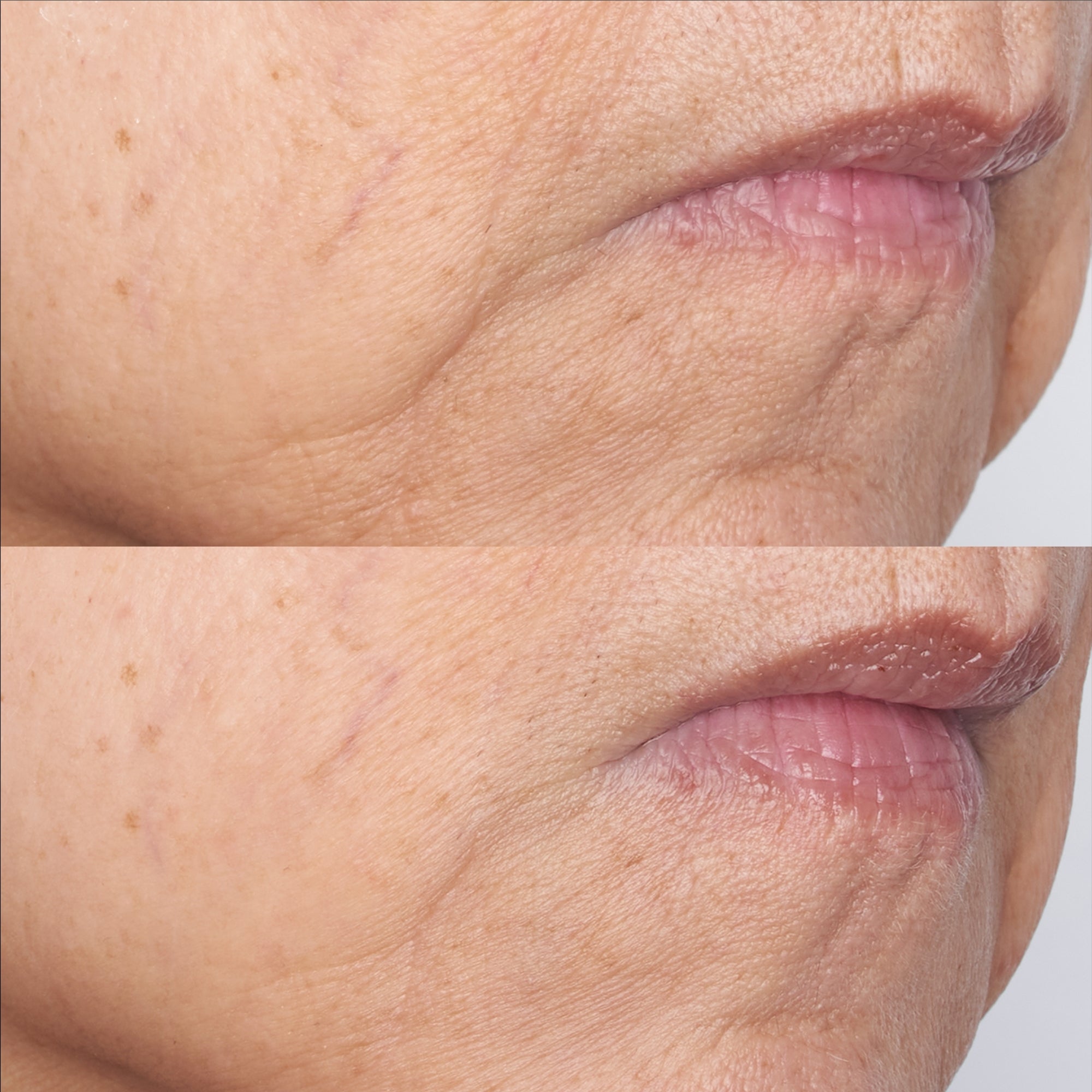 【新品未開封】ゴールデンビューティ ザ マスク＋ピュア フレッシュピーリング Cold Plasma Plus+ The Intensive Gel Mask | Perricone MD