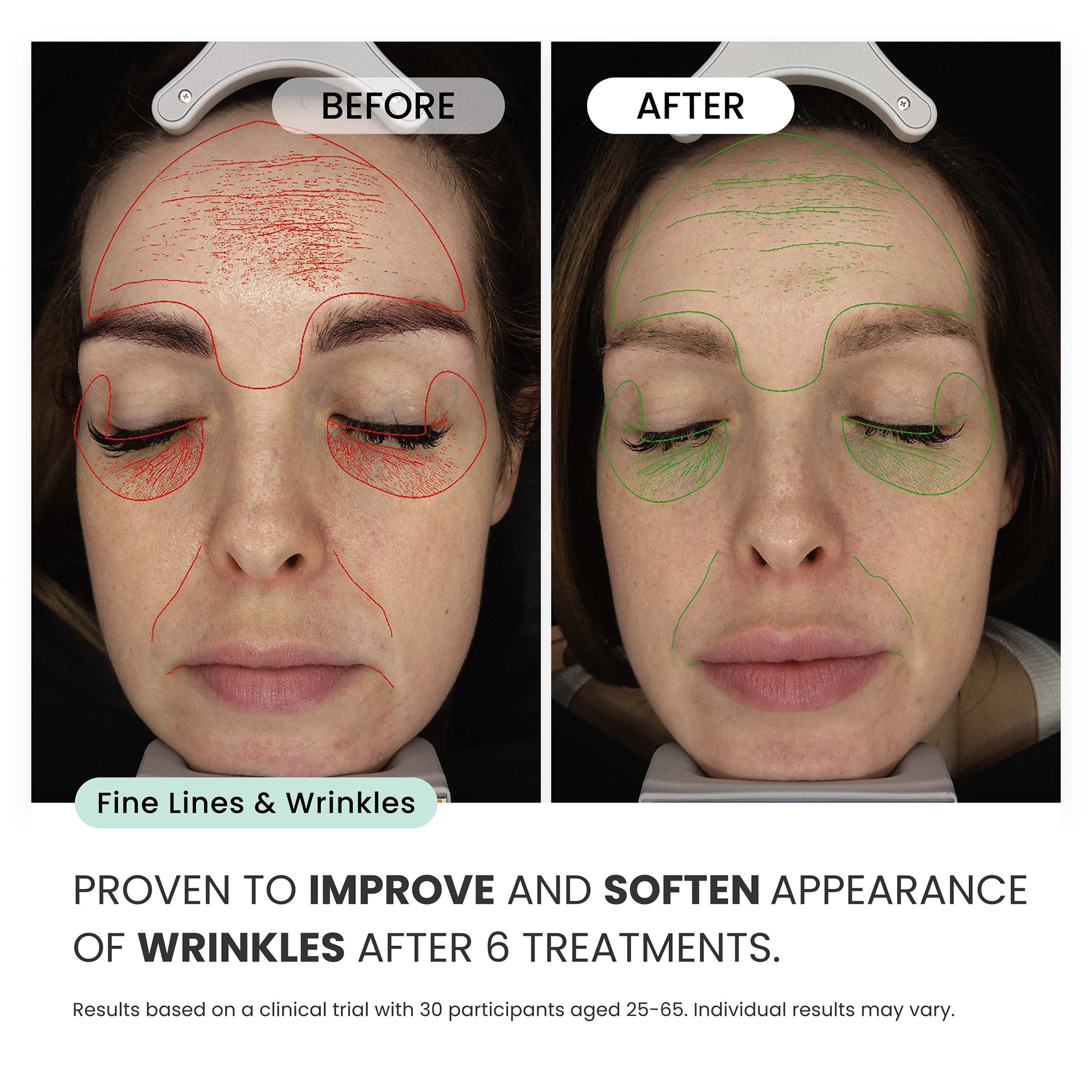 Qure Micro-Infusion System 3 Month Supply | Cult Beauty