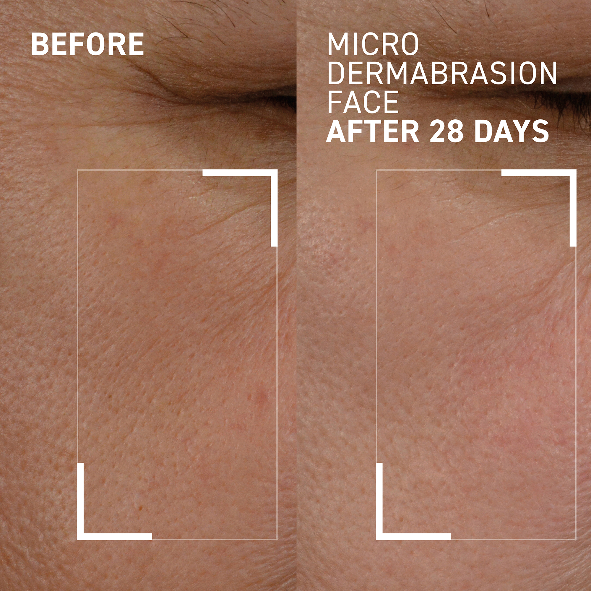 Microdermabrasion Renewing Age-Defying Face Exfoliator